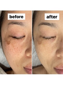 ココン(cocon)/シミ改善