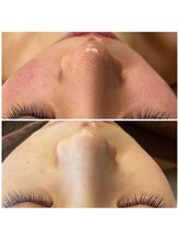 ビューティースタジオ ハンミ 福岡大名店(Beauty studio 韓美)/３Ｄ毛穴吸引