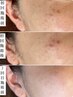 【2回目以降】業界初/シミ改善に特化した最新型"トーニングフォト【肌質改善