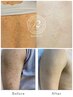 【医療提携】ハーブピーリング★剥離あり★背中上or二の腕♪結果重視!