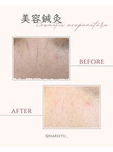 鍼灸院 ＨＡＲＩｅｙｕ/