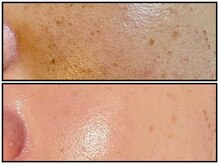 エンビロン最高峰120分2週間に一度4回目でこの効果！