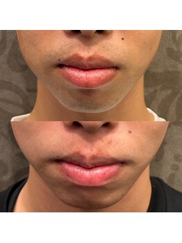 フェリーバ(FELIVA)/Before&After