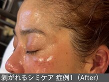 オアシスラグーン(OASIS LAGOON)/シミケア（症例1 施術3回）50代