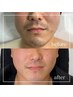 《男性限定》ヒゲ脱毛 20min