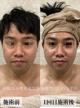 ラバ 名古屋栄店(LAVA)/小顔コルギ【むくみケア】