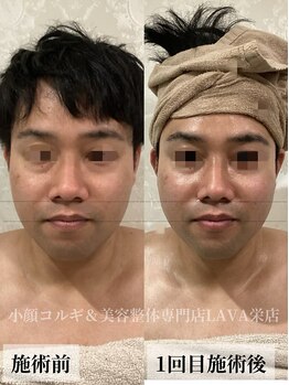 ラバ 名古屋栄店(LAVA)/小顔コルギ【むくみケア】