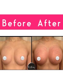 エルフラージュ 銀座店/年齢なんて関係ないハリツヤ胸