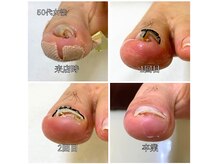 整体ハウス 健康堂(House)の雰囲気(【巻き爪改善例】あらゆる巻き爪に対応します!)