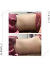 スキンホリック 恵比寿駅前店(SKIN HOLIC)/お腹☆ビフォア＆アフター★