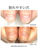 ブリエネイル/40代/縦筋/3ヶ月後アフター