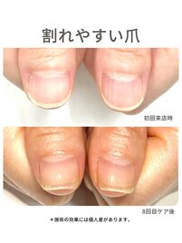 40代/縦筋/3ヶ月後アフター