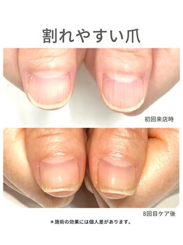 40代/縦筋/3ヶ月後アフター