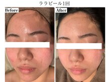 フレイヤ(FREYA)/ララピールBefore→After