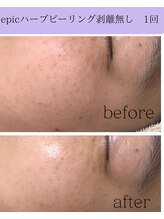 リラ(Lilas)/【epicハーブピーリング】1回目