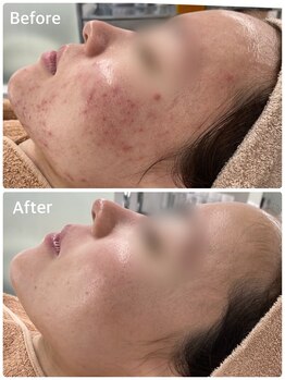 スハダビ110(suhadabi110)/before after