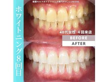 ルミエール 朝霧(Lumiere)の雰囲気(ショート照射(10分)でも白さを実感!フォトギャラリーにも掲載)