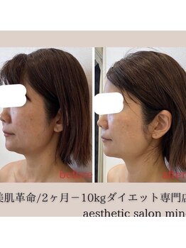 ミノ 美里大通り店(mino)/やみつきフェイシャル♪