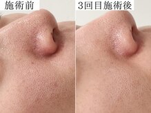 サロンドモフィ(salon de moffy)/美肌【エクソリフト】施術例４