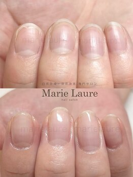 マリーロール 梅田店(Marie Laure)/深爪矯正/自爪育成/自爪風