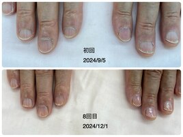 自爪育成