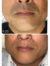 ラヴィエール(Laviere)/【メンズ脱毛】お髭