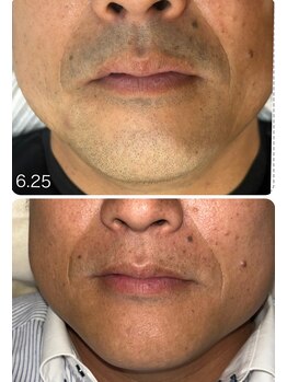 ラヴィエール(Laviere)/【メンズ脱毛】お髭