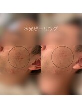 WA ネイル アンド ビューティー(WA nail & beauty)/水光ピーリング