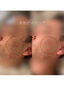 WA ネイル アンド ビューティー(WA nail & beauty)/水光ピーリング