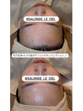 サロンドゥルシェル(salonde_le ciel)/DTなく水光肌スキンジェクション