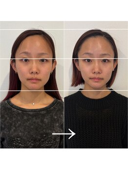 ドクターボディ 浜松店(Dr.Body)/【面長/中顔面縮小】