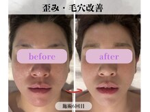 ミピマム 横浜駅前店/歪み・毛穴改善BeforeAfter