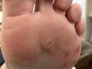 【お悩み事例】足裏ウオノメ