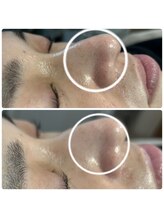 バイカラー(BY COLOR)/【ハイドラ毛穴洗浄】