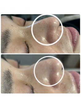 バイカラー(BY COLOR)/【毛穴洗浄】