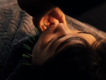 セント 江坂店(SCENT)/・・・美容鍼・・・