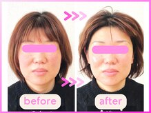 ホリハ整体院/*Before&After* 幹細胞美容鍼