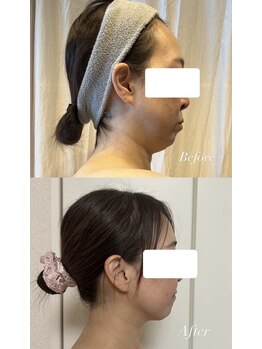 ヨサパーク インディゴ 都立大学(YOSA PARK Indigo)/二重顎・フェイスライン引き締め