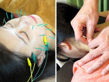 和み鍼灸院の写真/美容鍼スペシャル50分￥6600＋おまかせ60分￥6500（身体の鍼、整体、もみほぐし）110分￥13100→9900円♪
