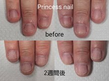 プリンセスネイル(Princess nail)/深爪矯正