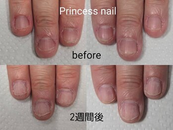プリンセスネイル(Princess nail)/深爪矯正