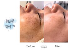 ディアスマイル(Dear.smile)/施術3回で