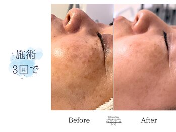 ディアスマイル(Dear.smile)/施術3回で