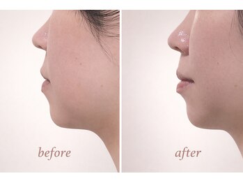 りんぱサロン まり/1回目のbefore &nbsp;after 