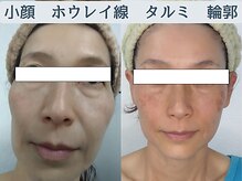 ソフィームの雰囲気（目の下頬のタルミほうれい線月に一度のケアです。）