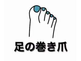 巻いた爪 フット 足の爪
