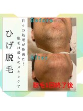 ソラ(SORA)/ヒゲ脱毛1回終了後