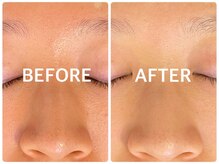 ハーブピーリング 恵比寿/小鼻毛穴引締めハーブピーリング