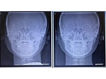 レントゲンでも検証済み/左右非対称・エラ・丸顔・面長を改善!!