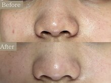 ティーツリー 名古屋 桜山(Tea Tree)/【毛穴ケア・毛穴洗浄】